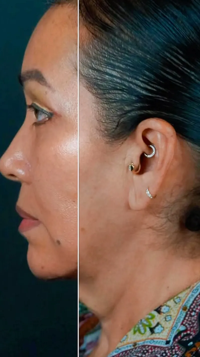 قبل وبعد - Deep Plane Facelift بواسطة د. Einar Mondragon