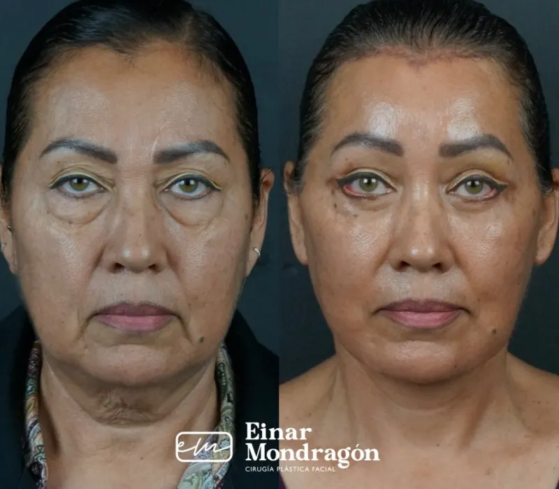 Before and after: Dr. Einar Mondragon