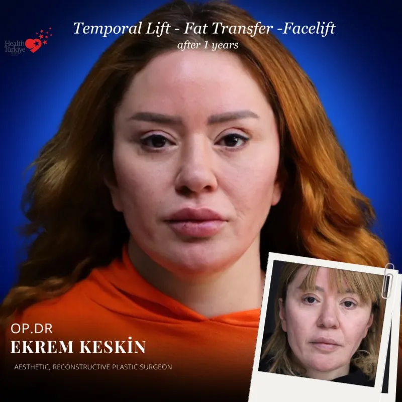 Before and after: Dr. Ekrem Keskin