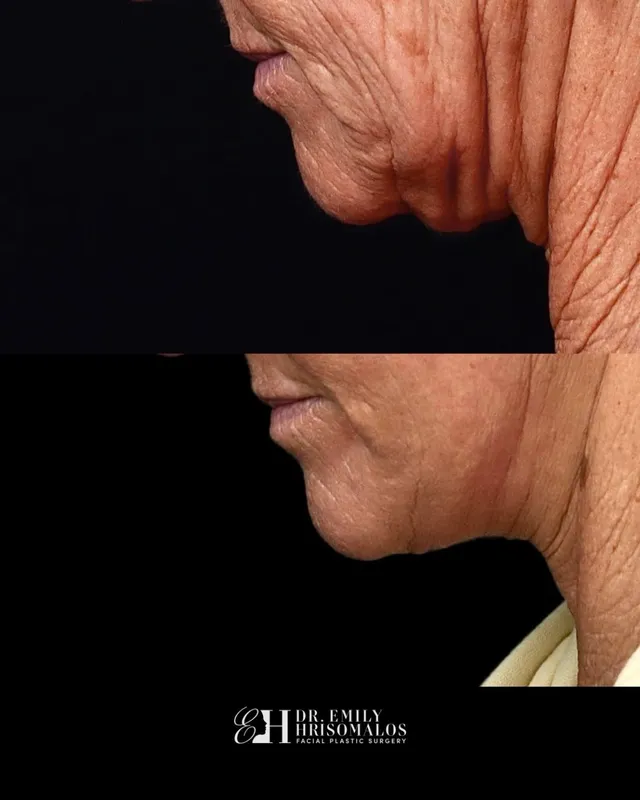 Before and after — Dr. Emily Hrisomalos