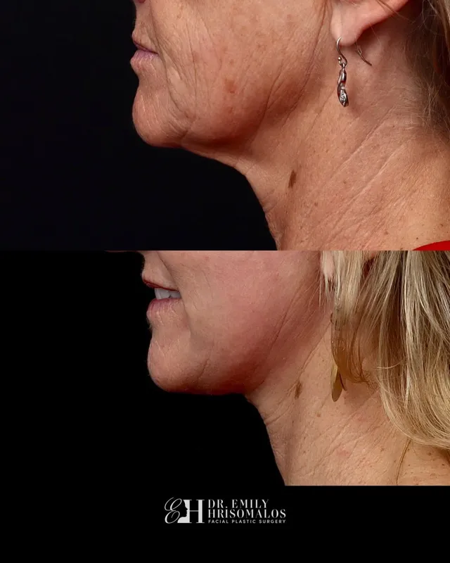 Before and after — Dr. Emily Hrisomalos