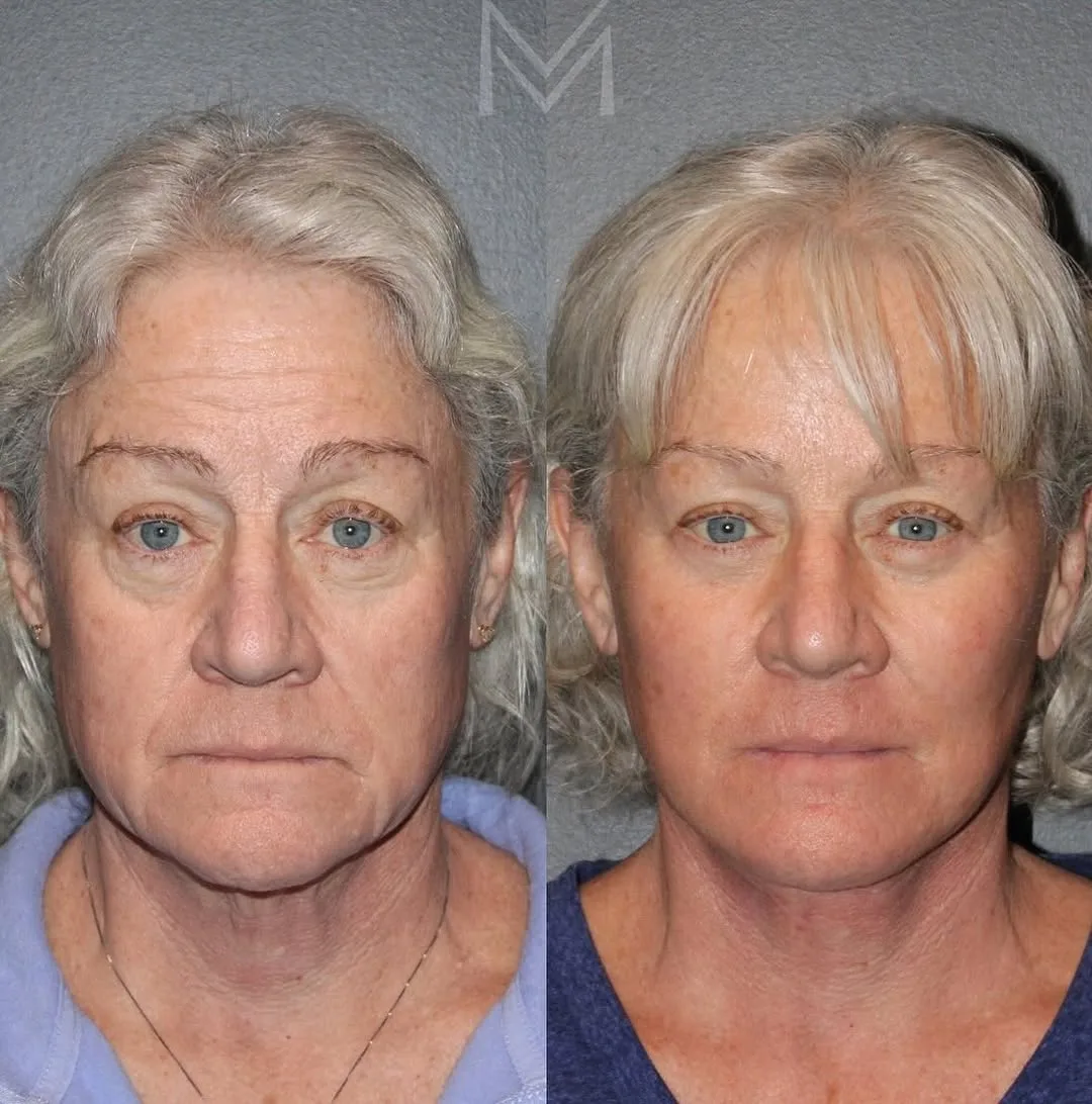 Before and after deep plane facelift — 65-year-old woman, frontal view, 3mo post-op by Dr. Emily Misch
