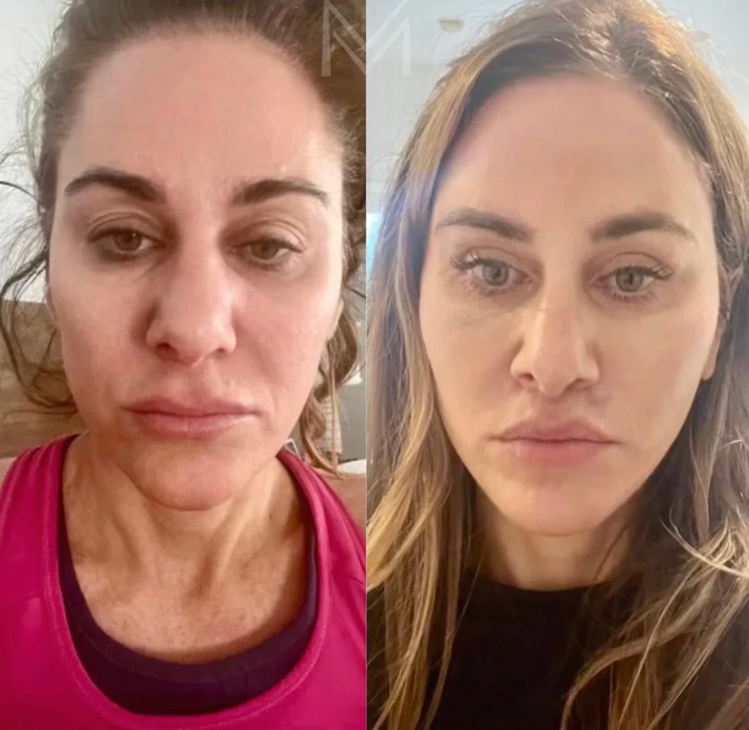 Before and after deep plane facelift — 45-year-old woman, frontal view, 6mo post-op by Dr. Emily Misch