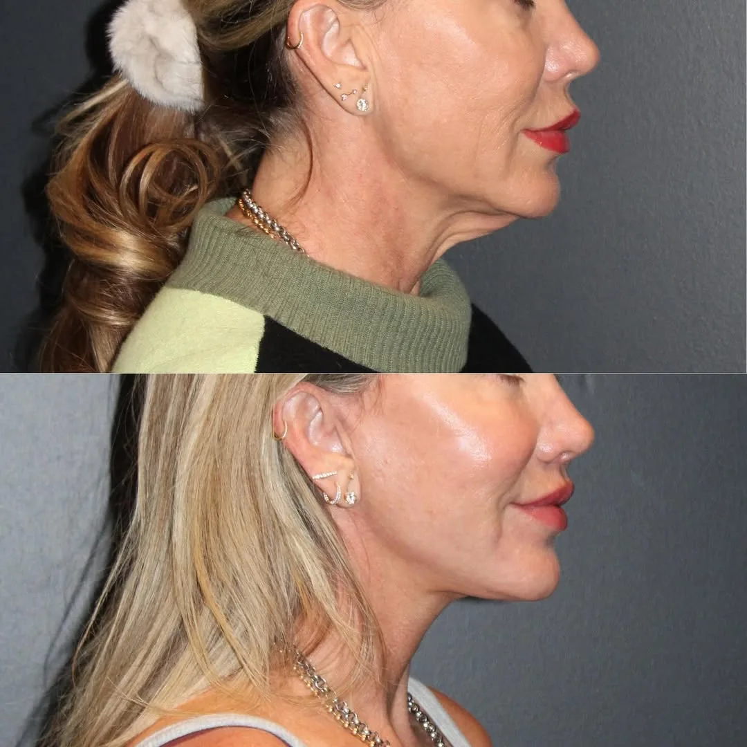Before and after deep plane facelift — 52-year-old woman, left profile view, 9mo post-op by Dr. Emily Misch