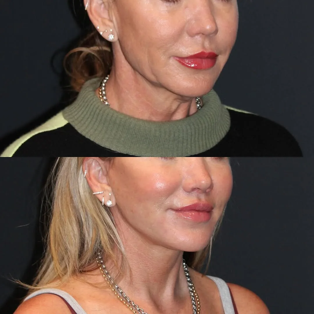 Before and after deep plane facelift — 52-year-old woman, oblique right view, 9mo post-op by Dr. Emily Misch