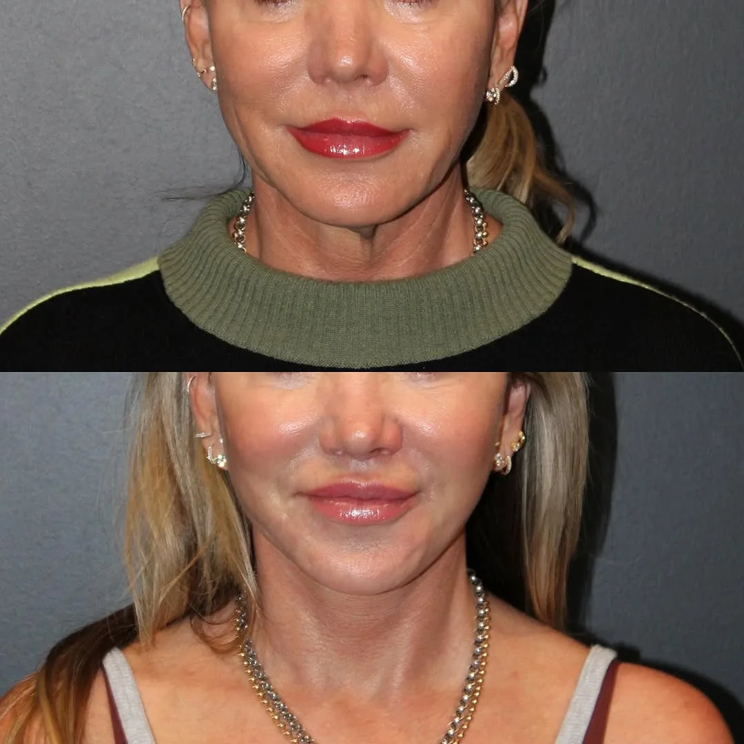 Before and after deep plane facelift — 52-year-old woman, frontal view, 7mo post-op by Dr. Emily Misch