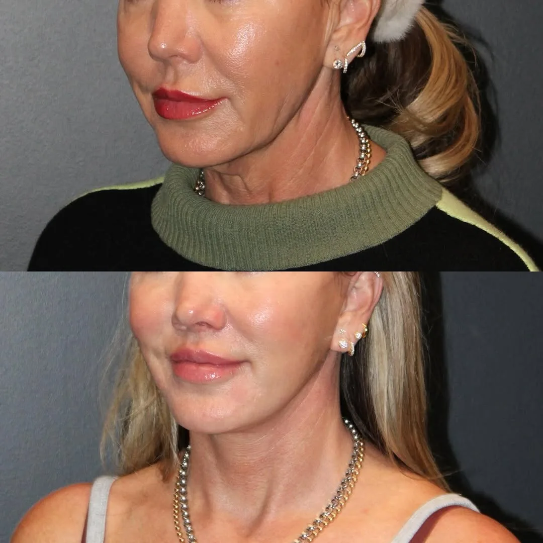 Before and after deep plane facelift — 52-year-old woman, oblique right view, 7mo post-op by Dr. Emily Misch