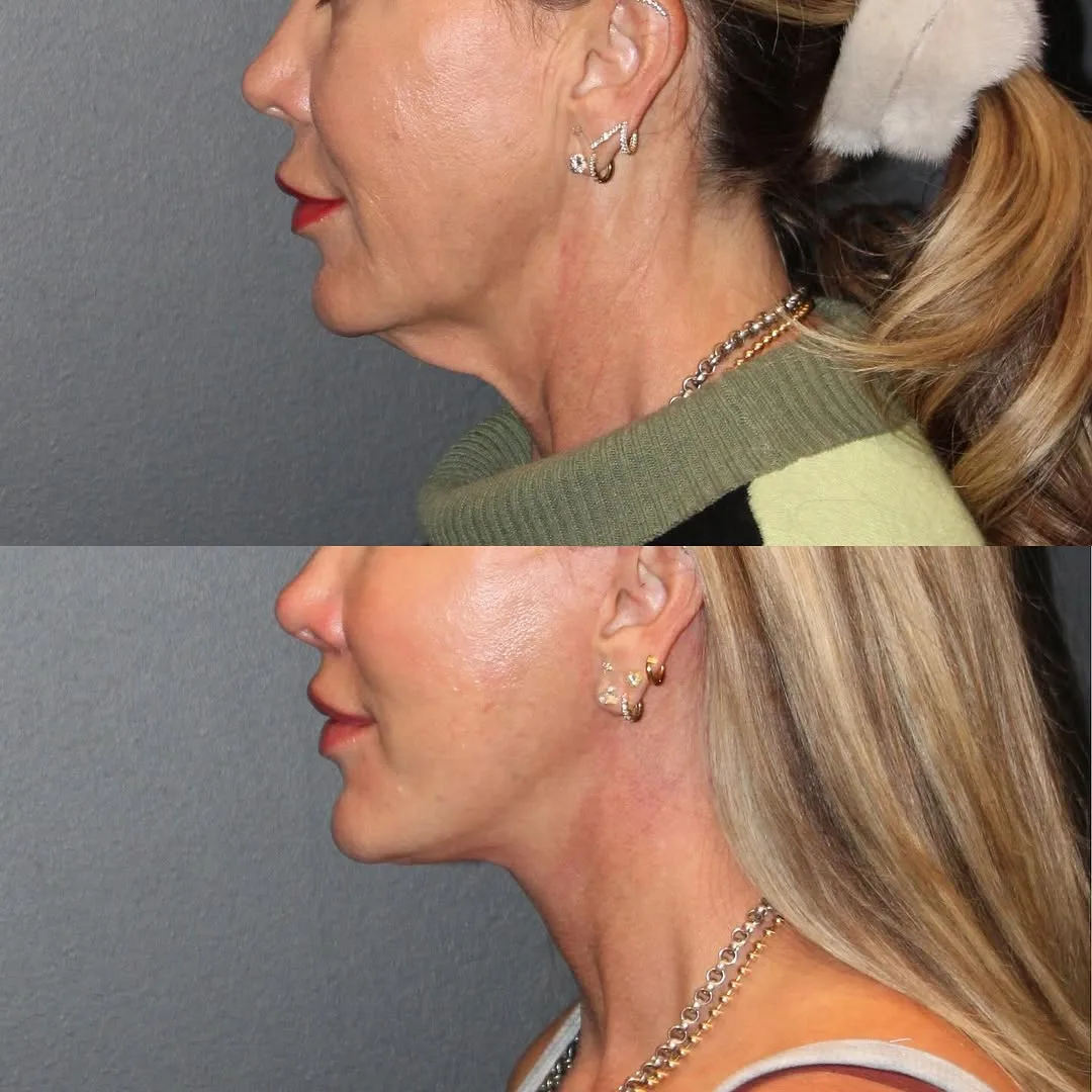 Before and after deep plane facelift — 52-year-old woman, left profile view, 6mo post-op by Dr. Emily Misch