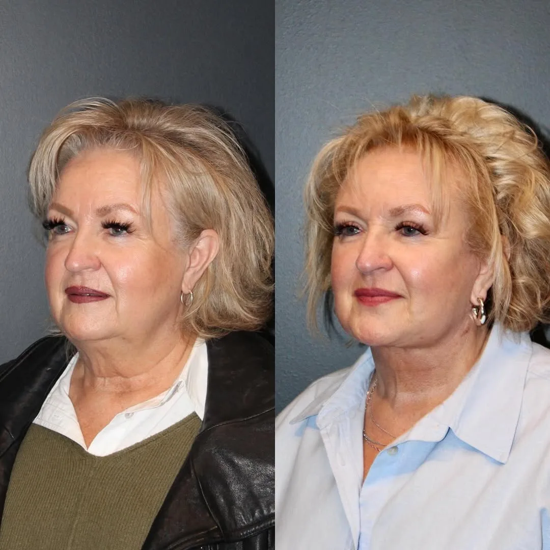 Before and after deep plane facelift — 65-year-old woman, oblique right view, 6mo post-op by Dr. Emily Misch