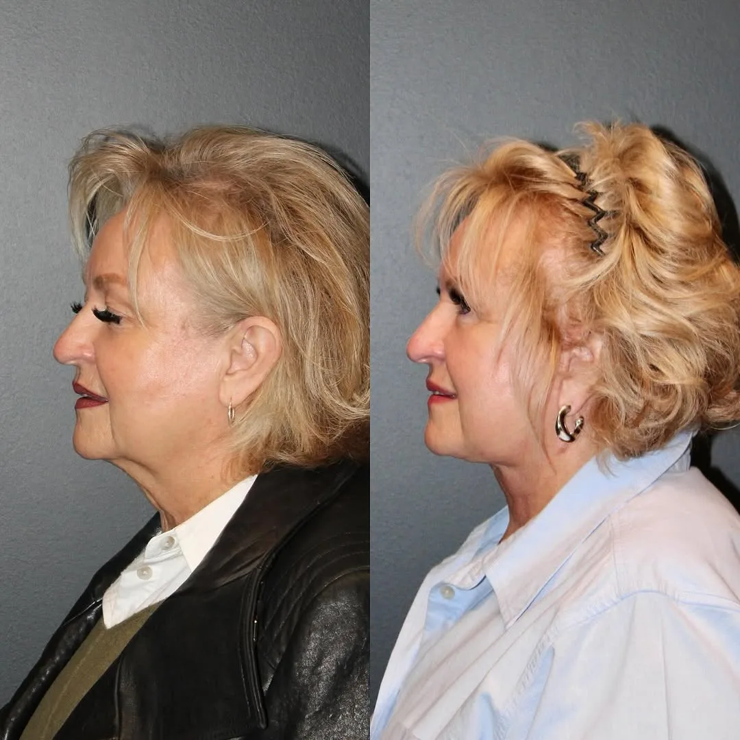 Before and after deep plane facelift — 65-year-old woman, right profile view, 6mo post-op by Dr. Emily Misch