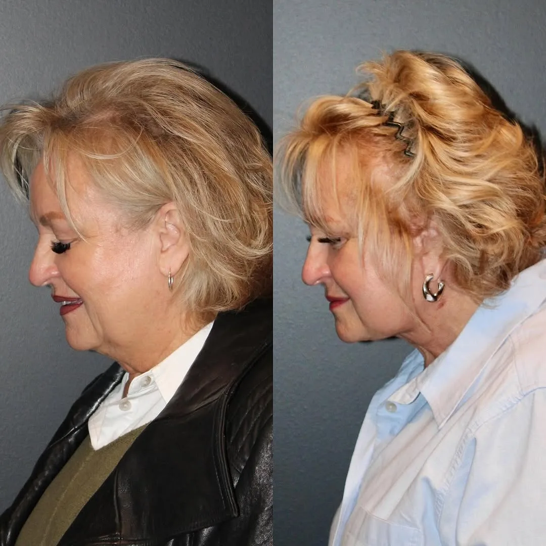 Before and after deep plane facelift — 65-year-old woman, left profile view, 9mo post-op by Dr. Emily Misch