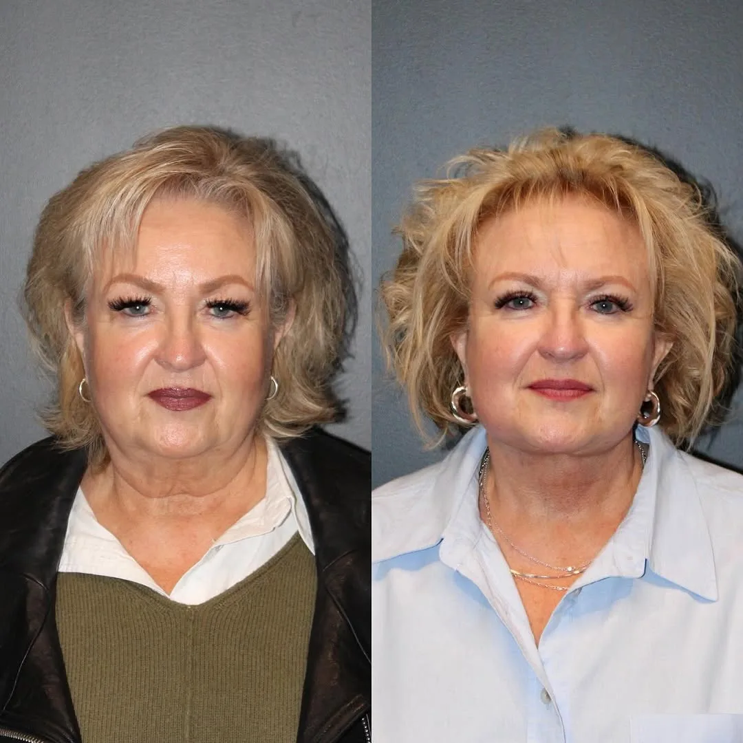 Before and after deep plane facelift — 65-year-old woman, frontal view, 7mo post-op by Dr. Emily Misch