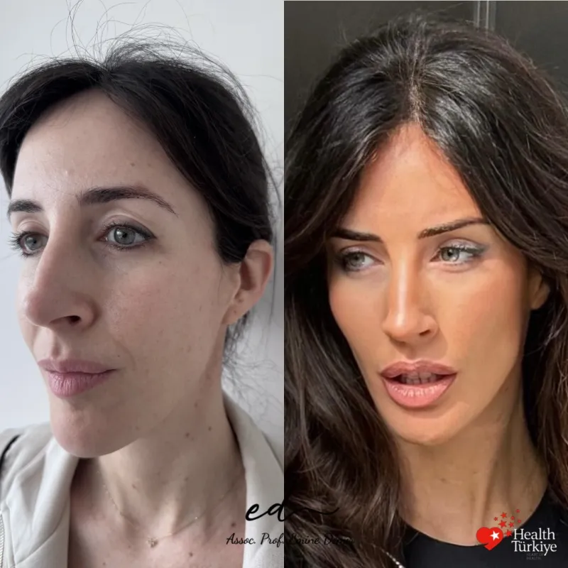 Before and after deep plane facelift, frontal view by Assoc. Prof. Emine Demir