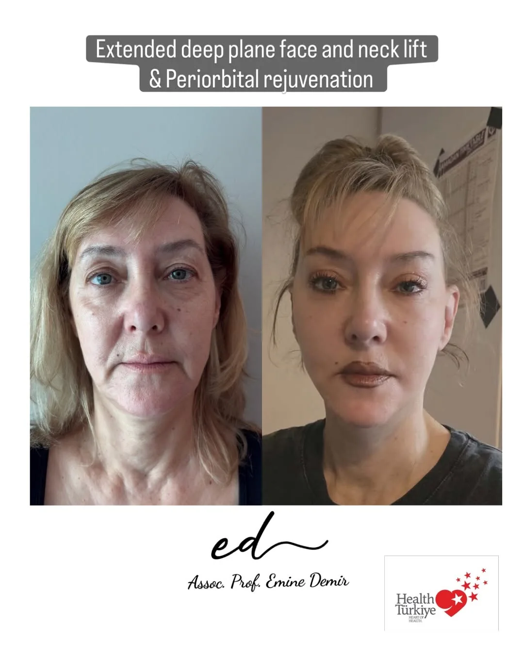 Before and after deep plane facelift — 55-year-old woman, frontal view, 6mo post-op by Assoc. Prof. Emine Demir
