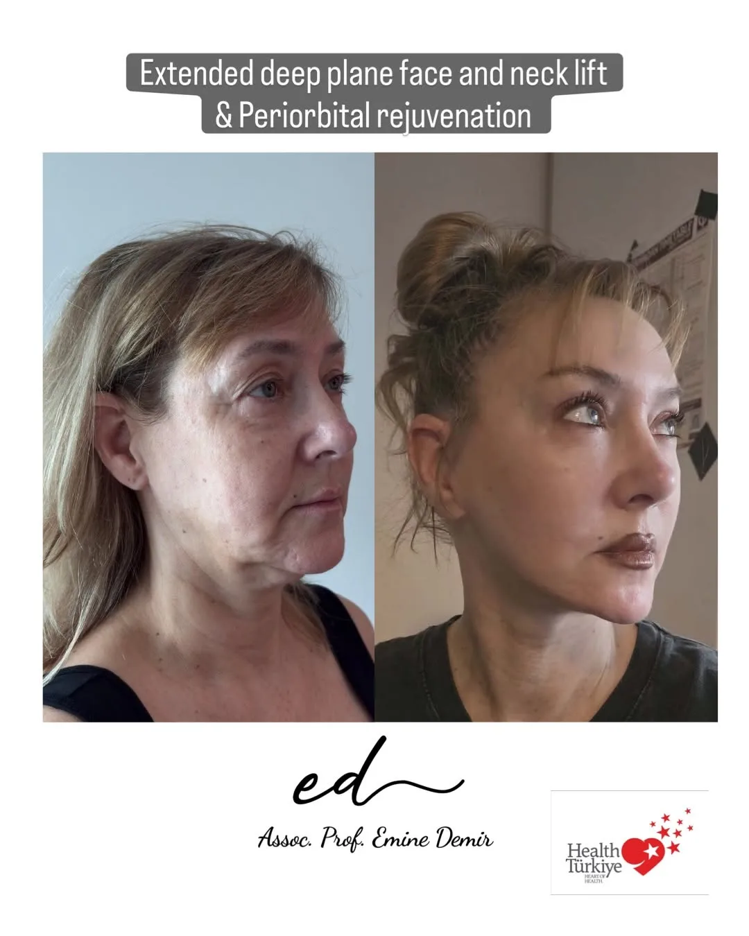 Before and after deep plane facelift — 55-year-old woman, three-quarter view, 6mo post-op by Assoc. Prof. Emine Demir