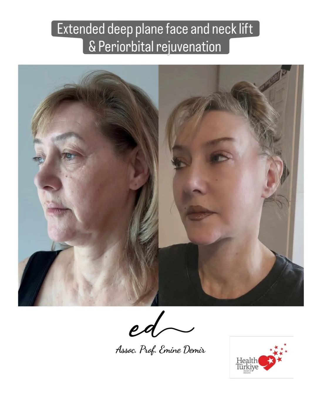 Before and after deep plane facelift — 55-year-old woman, right profile view, 6mo post-op by Assoc. Prof. Emine Demir