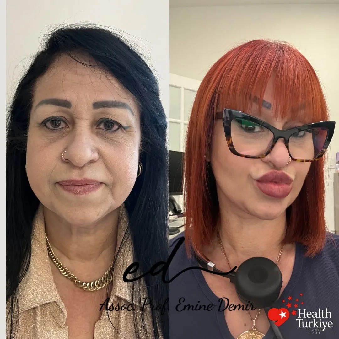 Before and after deep plane facelift — 55-year-old woman, oblique right view, 6mo post-op by Assoc. Prof. Emine Demir