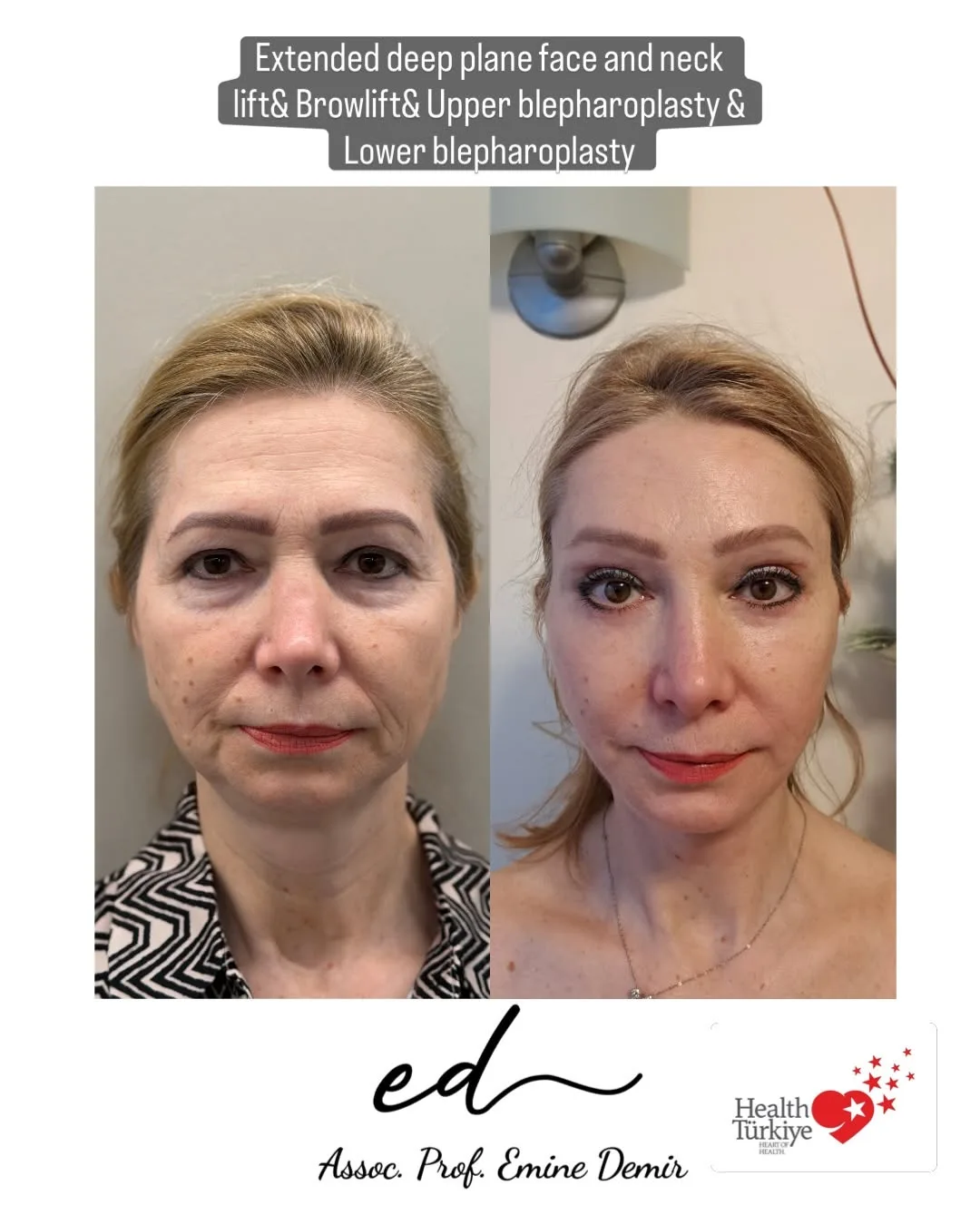 Before and after deep plane facelift — 55-year-old woman, frontal view, 6mo post-op by Assoc. Prof. Emine Demir