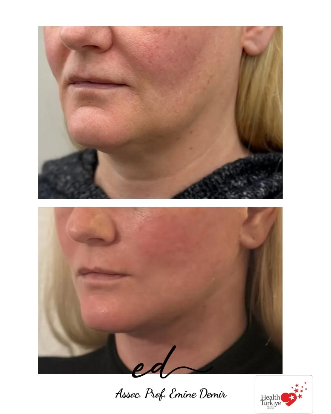 Before and after deep plane facelift — 45-year-old woman, oblique left view, 6mo post-op by Assoc. Prof. Emine Demir