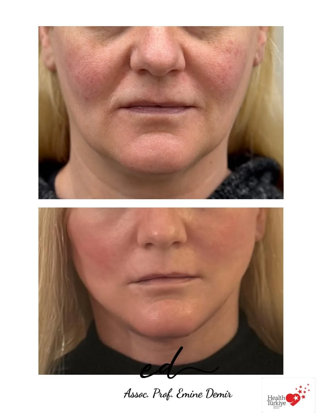 Before and after deep plane facelift — 55-year-old woman, frontal view, 6mo post-op by Assoc. Prof. Emine Demir
