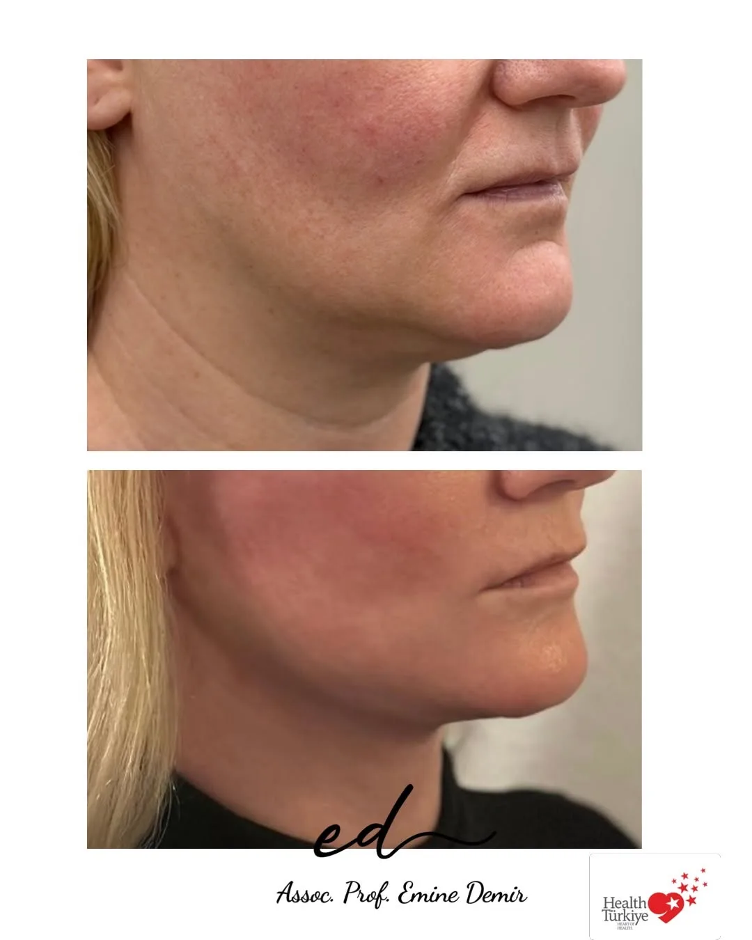 Before and after deep plane facelift — 45-year-old woman, right profile view, 6mo post-op by Assoc. Prof. Emine Demir