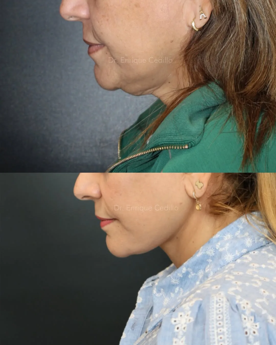 Before and after — Dr. Enrique Cedillo