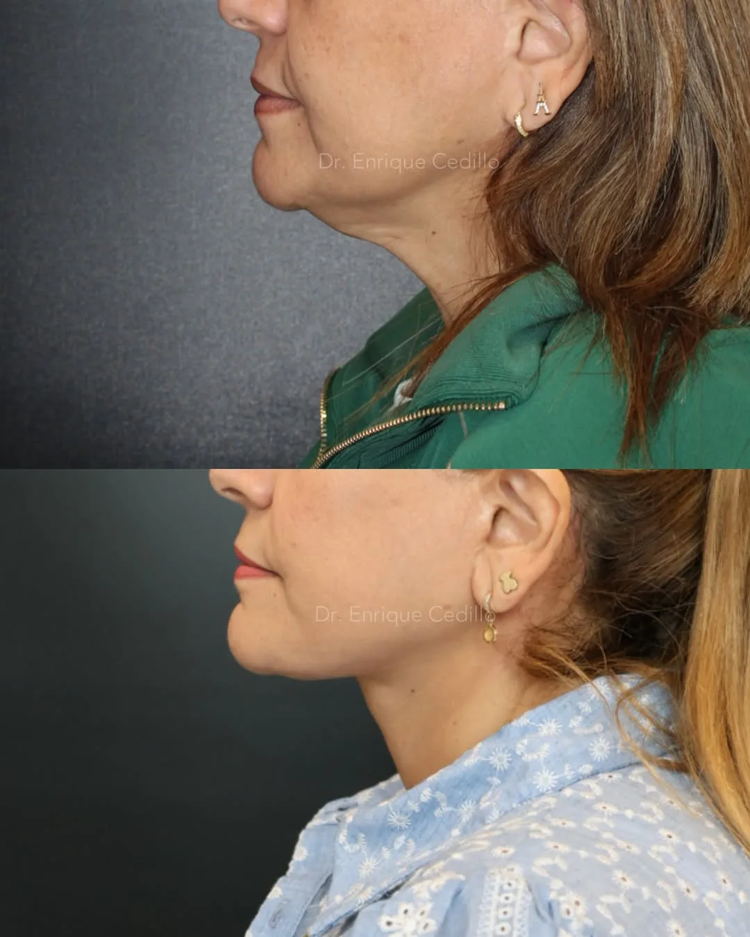 Before and after — Dr. Enrique Cedillo