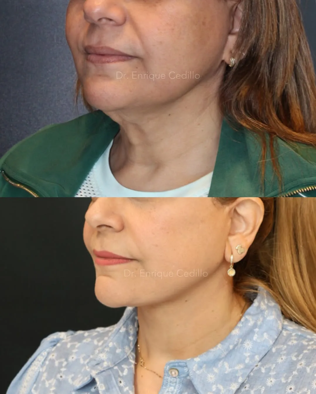 Before and after — Dr. Enrique Cedillo