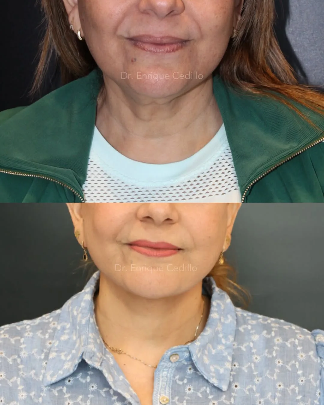 Before and after — Dr. Enrique Cedillo