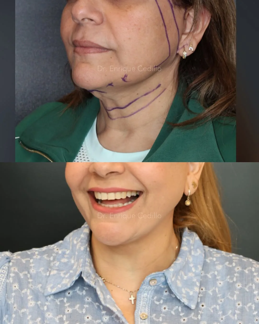 Before and after — Dr. Enrique Cedillo