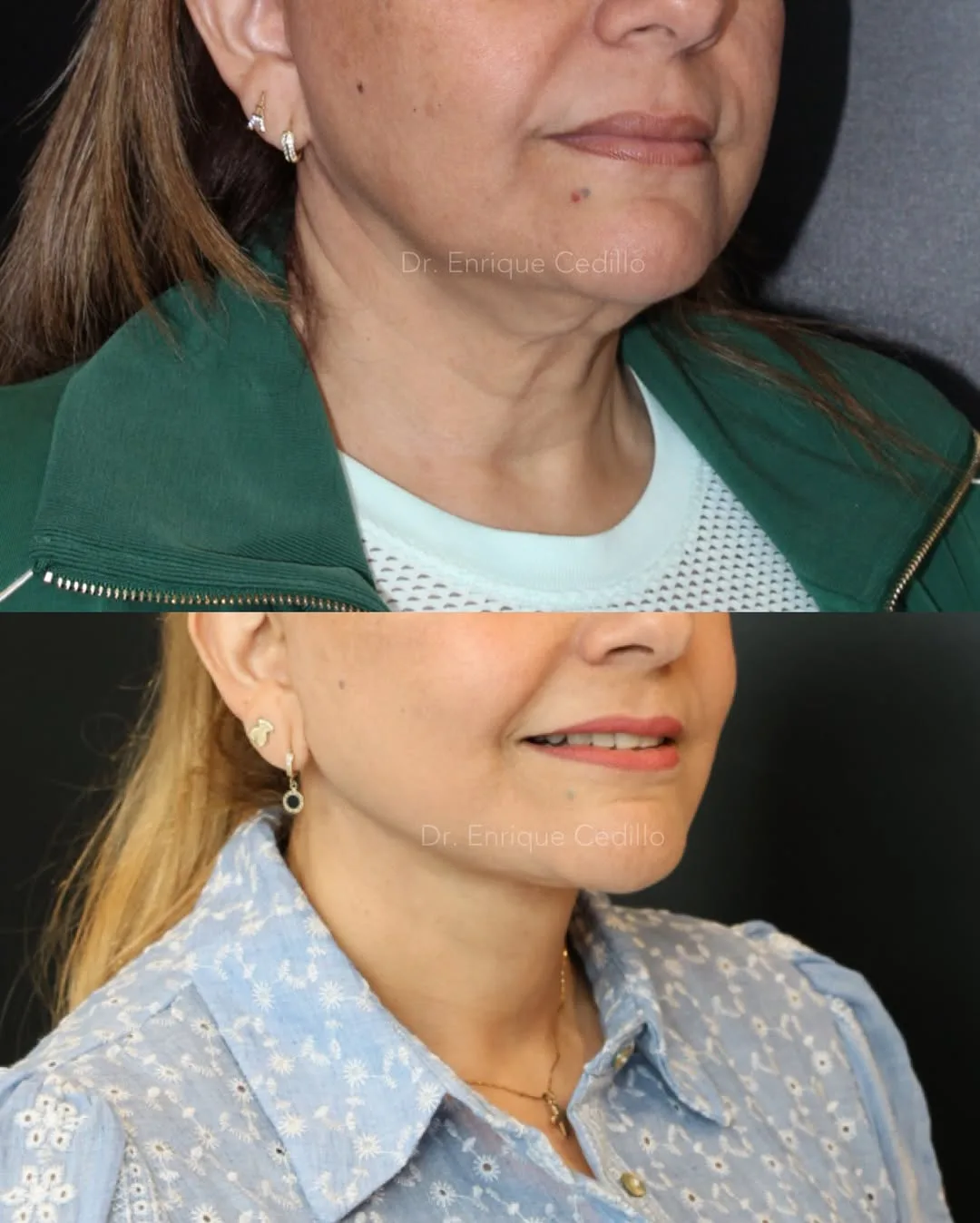 Before and after — Dr. Enrique Cedillo