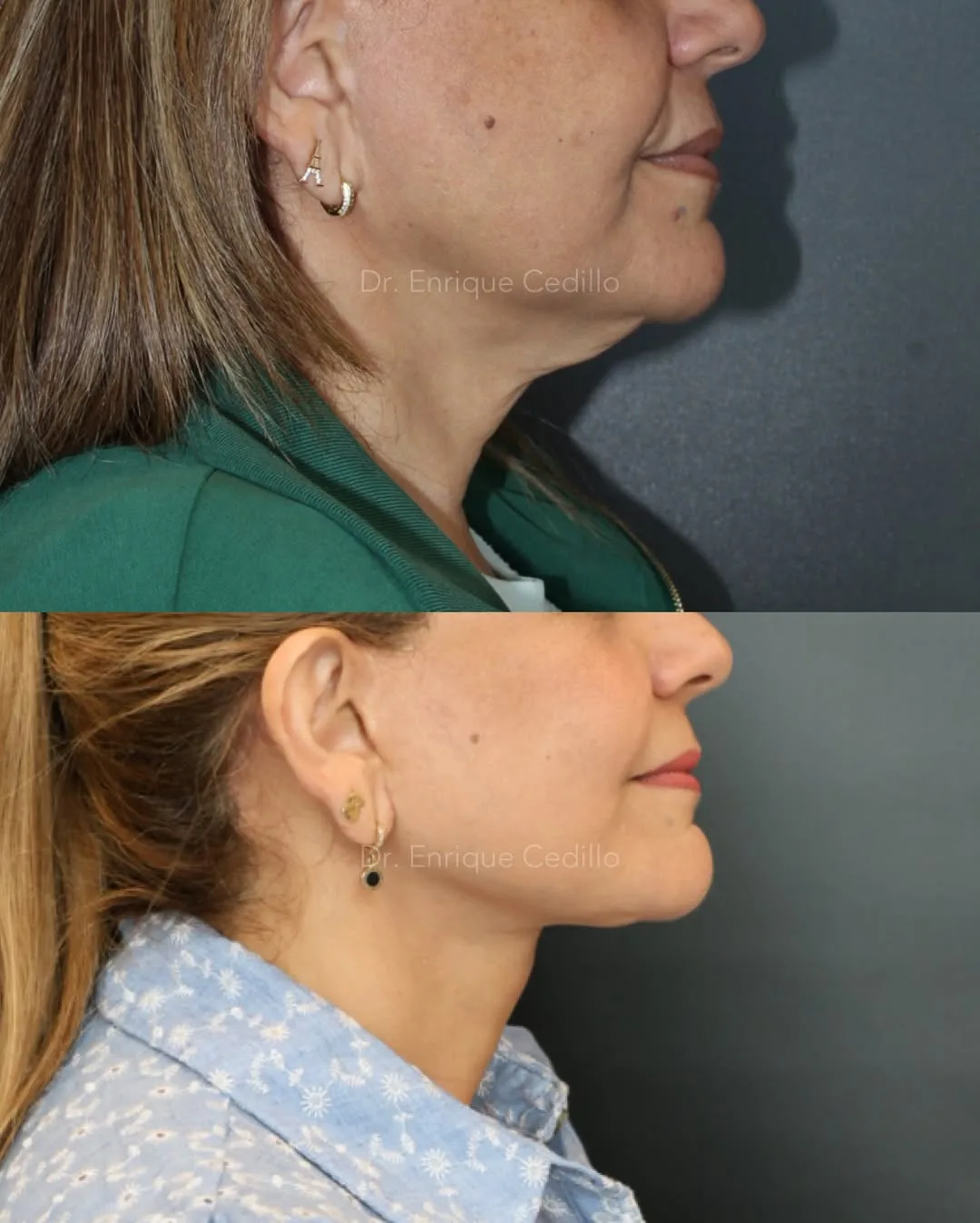Before and after — Dr. Enrique Cedillo