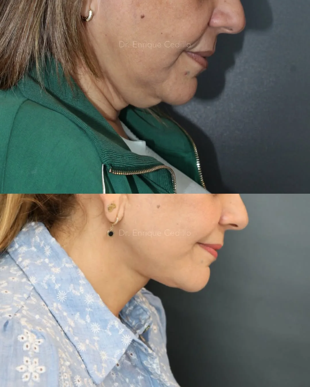 Before and after — Dr. Enrique Cedillo
