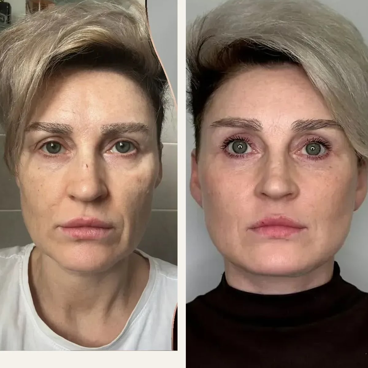 Before and after: Dr. Ercan Karacaoğlu