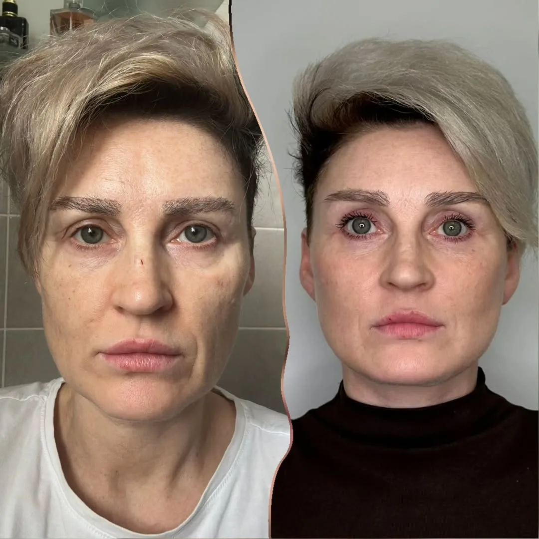 Before and after — Dr. Ercan Karacaoğlu