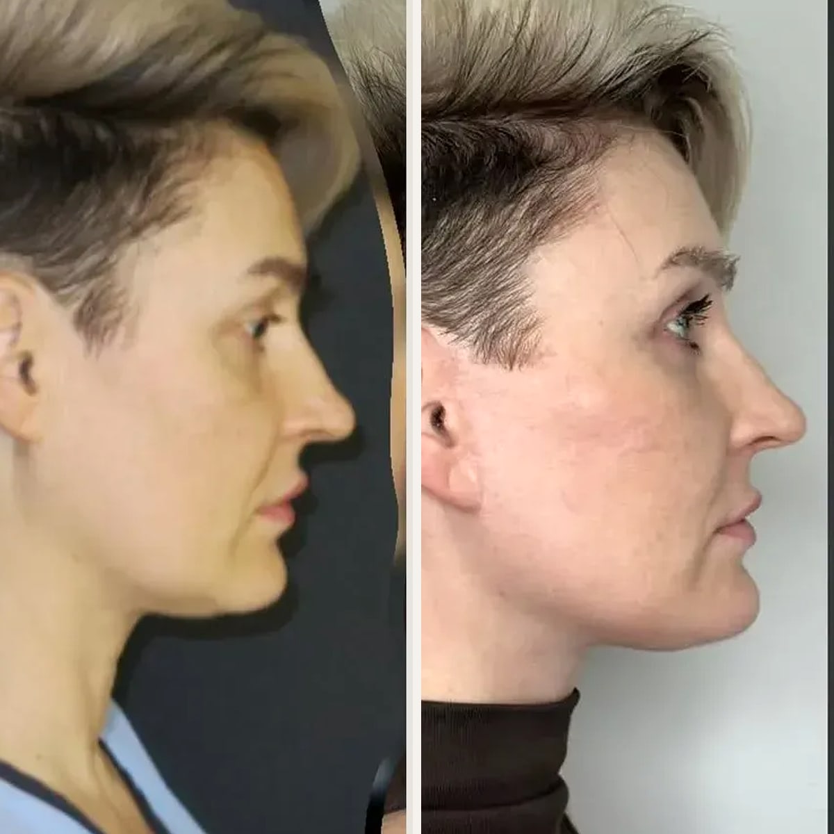 Before and after: Dr. Ercan Karacaoğlu