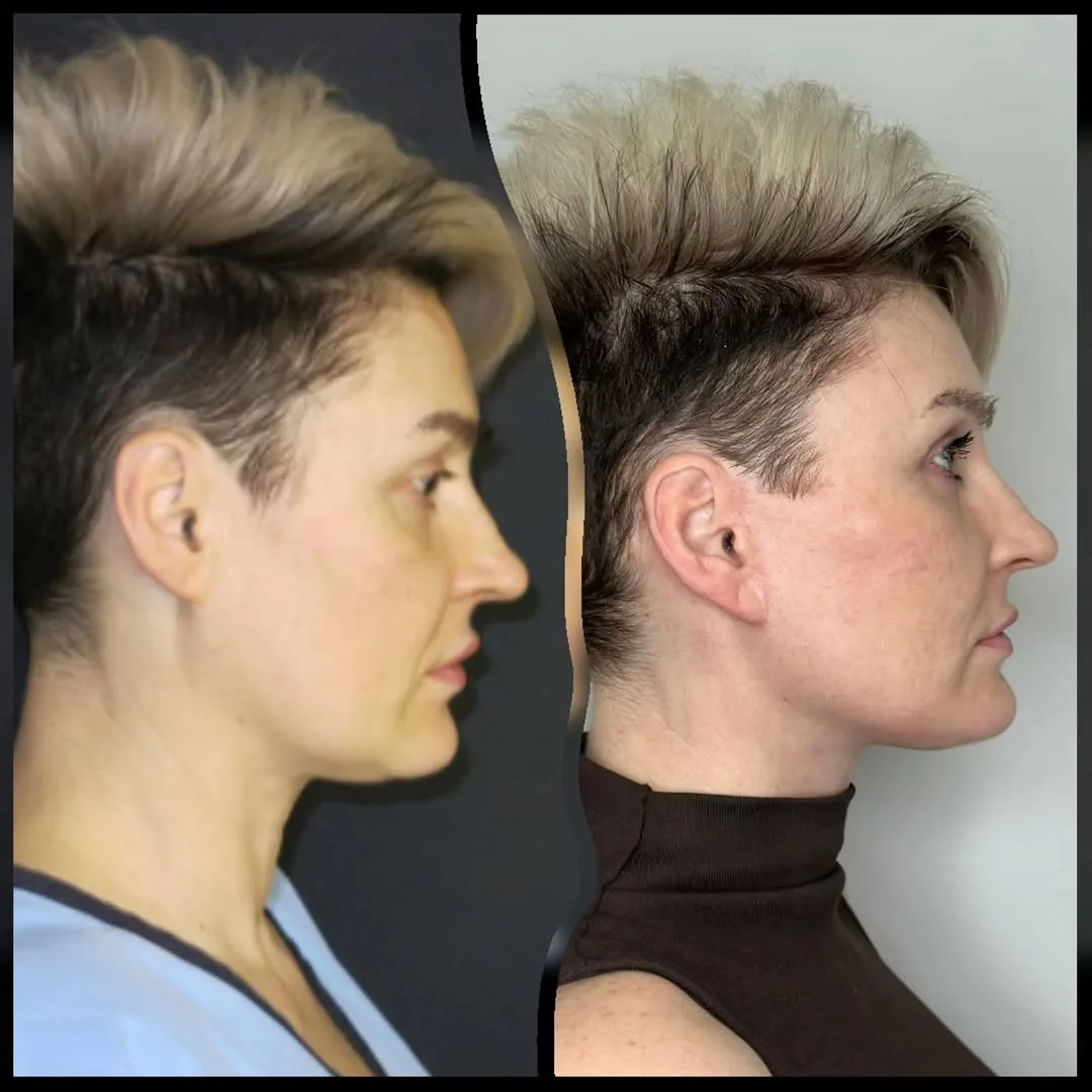 Before and after — Dr. Ercan Karacaoğlu