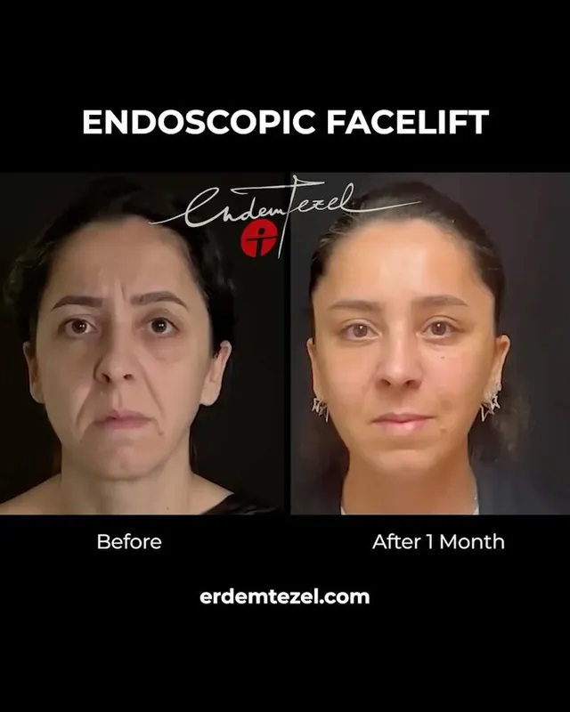 Before and after — Prof. Erdem Tezel