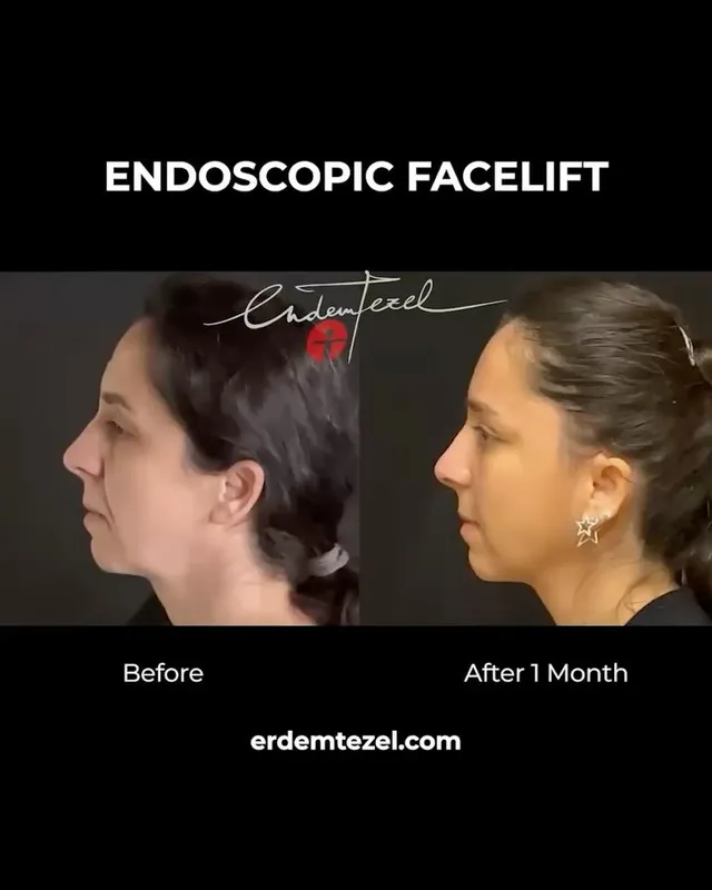 Before and after — Prof. Erdem Tezel