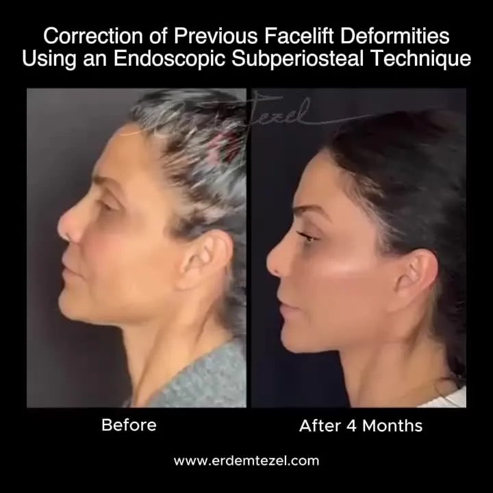 Before and after — Prof. Erdem Tezel