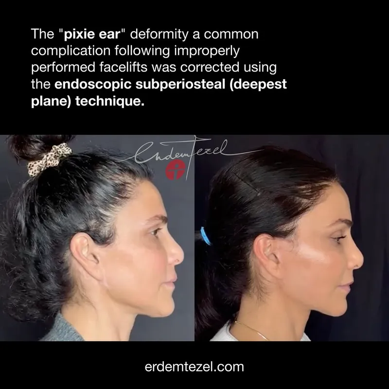 Before and after — Prof. Erdem Tezel
