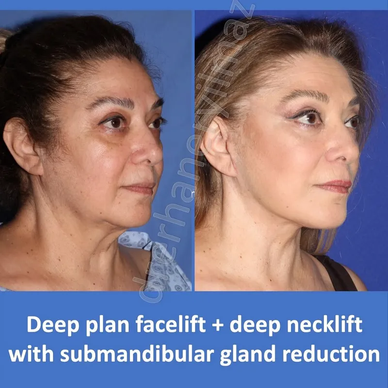 Before and after deep plane facelift, frontal view by Dr. Erhan Eryılmaz