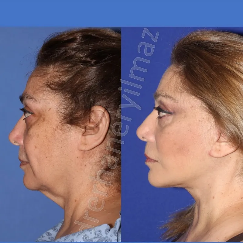 Before and after deep plane facelift, frontal view by Dr. Erhan Eryılmaz