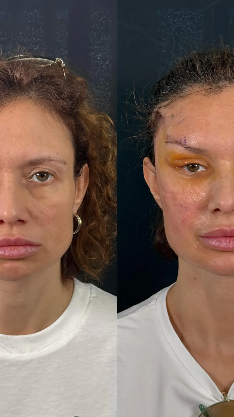 Before and after — Dr. Erhan Gezer