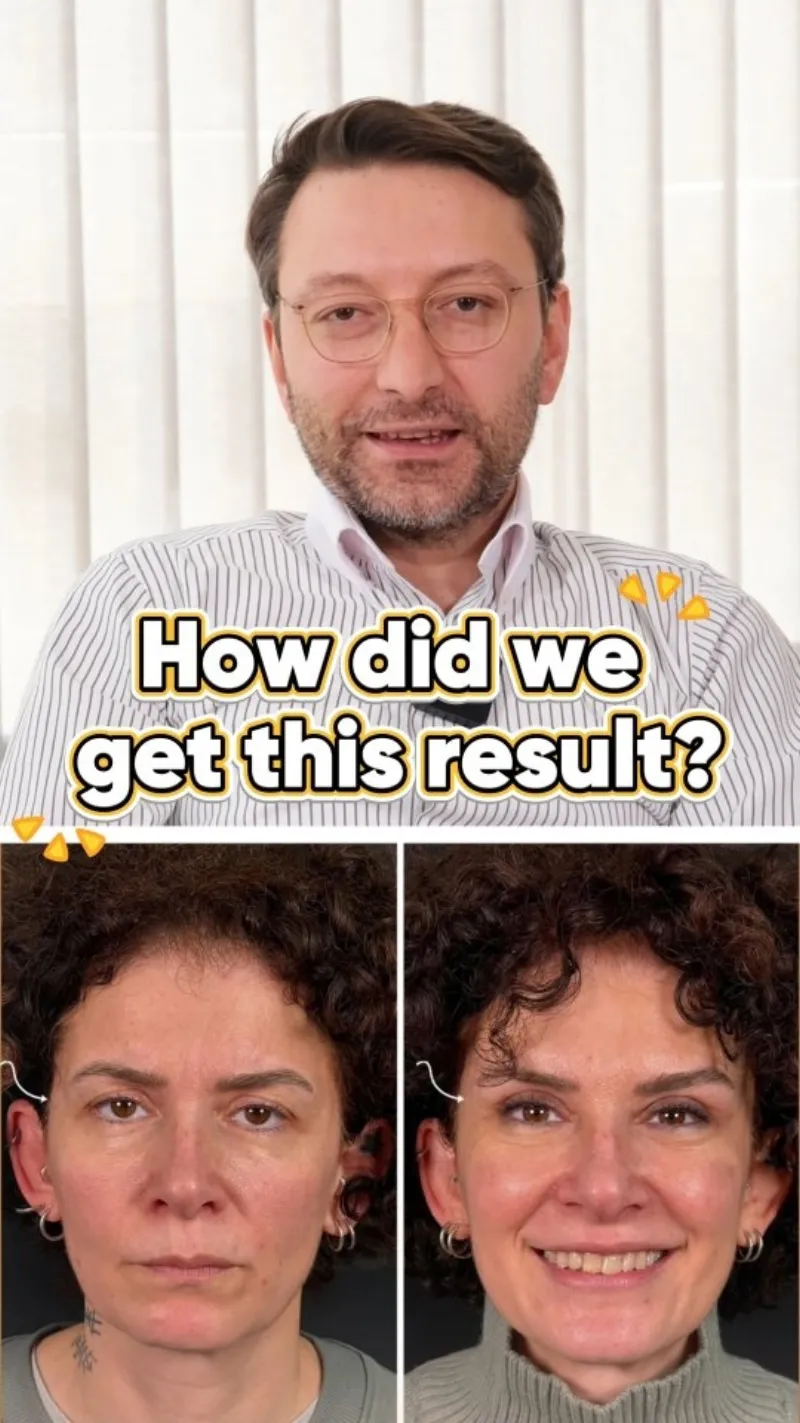 Before and after — Dr. Erhan Gezer
