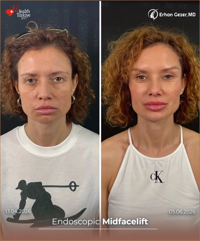 Before and after — Dr. Erhan Gezer