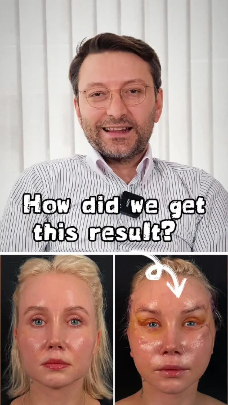 Before and after — Dr. Erhan Gezer