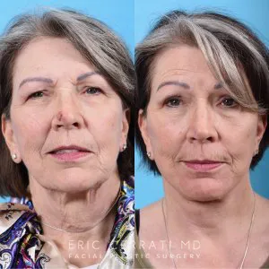 Before and after deep plane facelift — 65-year-old woman, oblique left view, 6mo post-op by Dr. Eric Cerrati