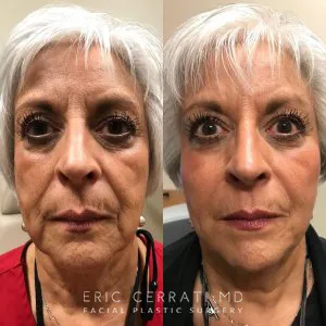 Before and after deep plane facelift — 65-year-old woman, frontal view, 6mo post-op by Dr. Eric Cerrati