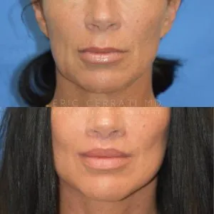 Before and after deep plane facelift — 55-year-old woman, frontal view, 6mo post-op by Dr. Eric Cerrati